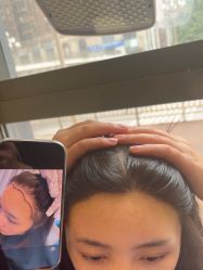 -碧莲盛·不剃发植发