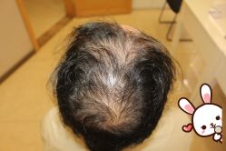 -大麦微针植发丨全国连锁