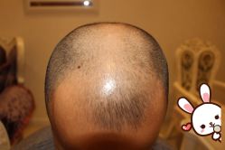 -大麦微针植发丨全国连锁