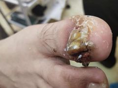 -祖传修脚甲沟炎灰指甲鸡眼