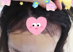 -大麦微针植发全国连锁