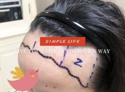 -大麦微针植发全国连锁