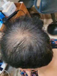 -碧莲盛·不剃发植发