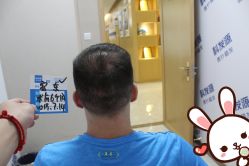 -大麦微针植发丨全国连锁