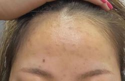 体验后-CHUXIN初心·敏感·痘痘修护中心