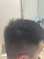 -碧莲盛·不剃发植发