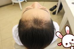 点击看大图 -大麦微针植发丨全国连锁