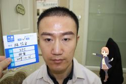 -大麦微针植发丨全国连锁