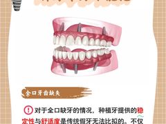 -上海仁爱医院口腔科 · 种植