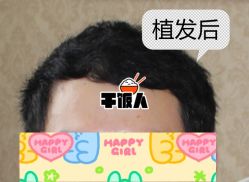 -大麦微针植发全国连锁