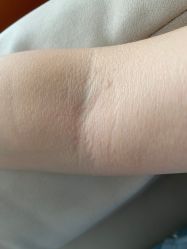 -美丽人生祛斑扁平疣汗管瘤中心
