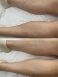 -薇兰专业脱毛连锁机构