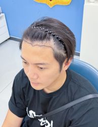 -大麦微针植发丨全国连锁
