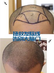 -大麦微针植发全国连锁