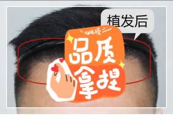 -大麦微针植发全国连锁