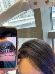 -碧莲盛·不剃发植发