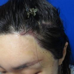 -碧莲盛不剃发植发