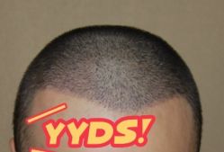 -大麦微针植发丨全国连锁