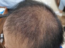 -碧莲盛·不剃发植发