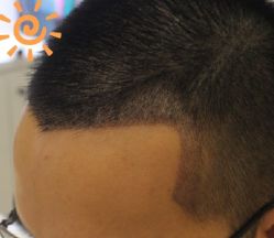 -大麦微针植发丨全国连锁