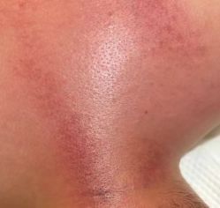 -苑苑vbeauty科技美容SPA