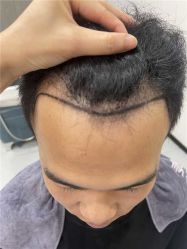 -大麦微针植发全国连锁