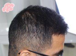 -大麦微针植发丨全国连锁