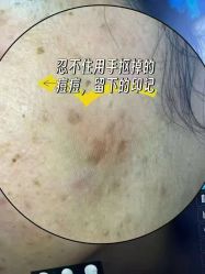 -瑶芳清颜草本祛痘