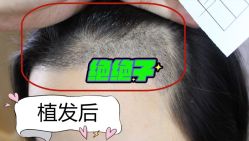 -大麦微针植发全国连锁