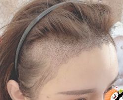 -大麦微针植发丨全国连锁