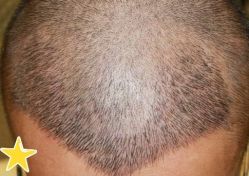 -大麦微针植发丨全国连锁