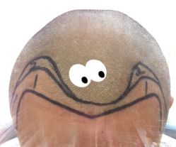 -大麦微针植发全国连锁