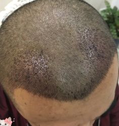 -大麦微针植发丨全国连锁