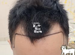 -大麦微针植发全国连锁