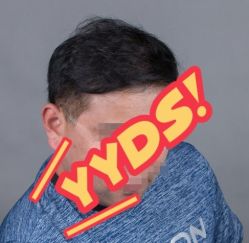 -大麦微针植发丨全国连锁