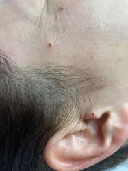 -痣斑堂·取大痣