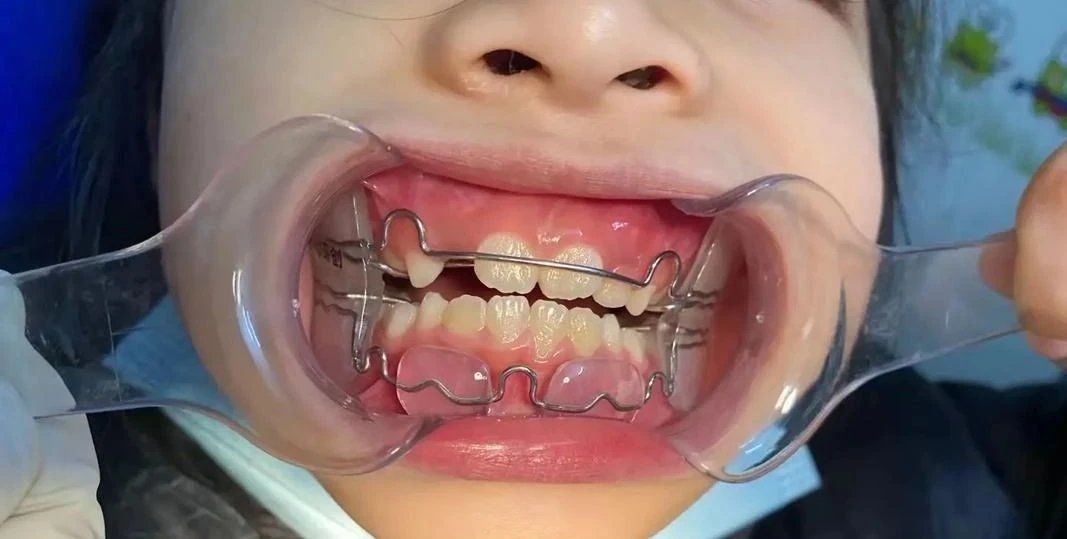 儿童早期干预矫正有必要吗?用哪种矫治器?