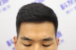 -大麦微针植发丨全国连锁