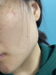 体验后-深圳春天阳光医院·轮廓抗衰中心