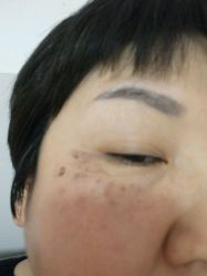 点击看大图 提斑做完三天-北京英煌医疗美容
