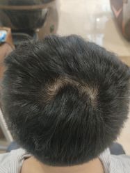 -碧莲盛·不剃发植发