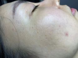 体验前-爱莎扁平疣·汗管瘤·斑痣中心