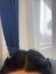 -碧莲盛·不剃发植发
