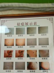 -痣清宫祛斑祛痣连锁店