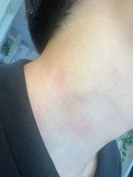 -美丽人生祛斑扁平疣汗管瘤中心