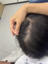 -大麦微针植发全国连锁