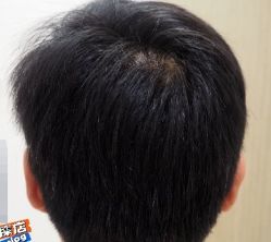 -大麦微针植发丨全国连锁