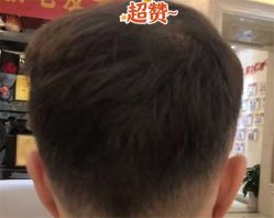 -大麦微针植发全国连锁