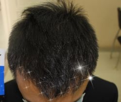 -大麦微针植发全国连锁
