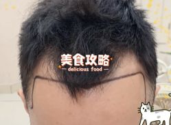 -大麦微针植发全国连锁